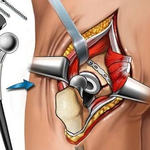hip replacement surgeon in warangal